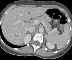 Hemangioma - CTisus CT Scan