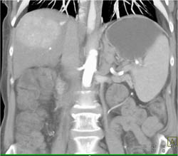 Hepatoma - CTisus CT Scan