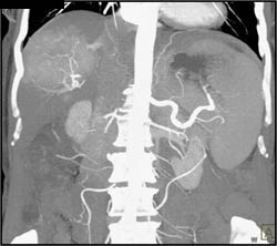 Hepatoma - CTisus CT Scan