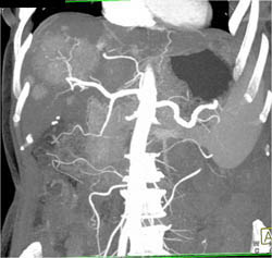 Hepatoma - CTisus CT Scan