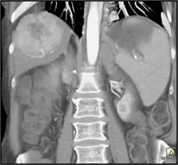 Hepatoma - CTisus CT Scan