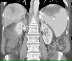 Hepatoma - CTisus CT Scan