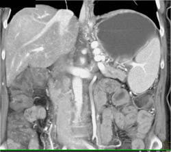 Hepatoma - CTisus CT Scan