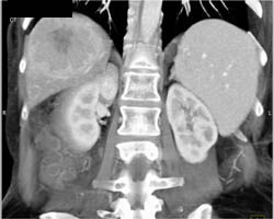 Hepatoma - CTisus CT Scan