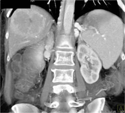 Hepatoma - CTisus CT Scan