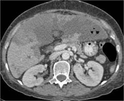 Hepatic Infarction S/P Liver Transplant - CTisus CT Scan