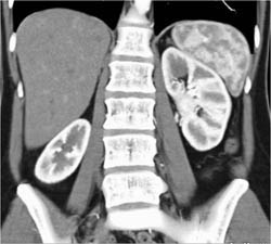 Subtle Vascular Liver Lesion Best Seen on Venous Phase- Probable Hemangioma - CTisus CT Scan