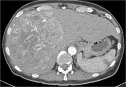 Hepatoma With Neovascularity - CTisus CT Scan