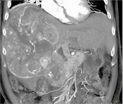 Hepatoma With Neovascularity - CTisus CT Scan