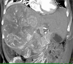 Hepatoma With Neovascularity - CTisus CT Scan