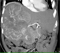 Hepatoma With Neovascularity - CTisus CT Scan