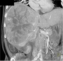 Hepatoma With Neovascularity - CTisus CT Scan