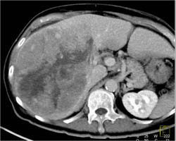 Hepatoma With Neovascularity - CTisus CT Scan