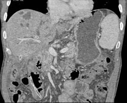 Liver Abscess - CTisus CT Scan