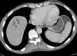 Liver Abscess - CTisus CT Scan