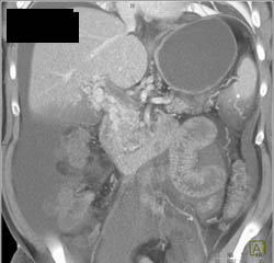 Cavernous Transformation of the Portal Vein (CTPV) With Cirrhosis - CTisus CT Scan