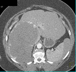 Giant Hemangioma - CTisus CT Scan