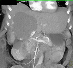 Giant Hemangioma - CTisus CT Scan