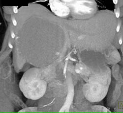 Giant Hemangioma - CTisus CT Scan