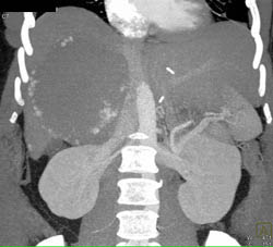 Giant Hemangioma - CTisus CT Scan