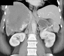 Giant Hemangioma - CTisus CT Scan