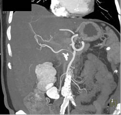 Hepatoma - CTisus CT Scan