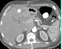 Hepatoma - CTisus CT Scan