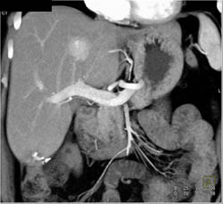 Focal Nodular Hyperplasia (FNH) - CTisus CT Scan