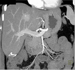 Focal Nodular Hyperplasia (FNH) - CTisus CT Scan