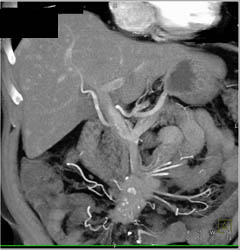 Liver Metastases Due to Carcinoid Tumor- Note Mass in Root of Mesentery - CTisus CT Scan