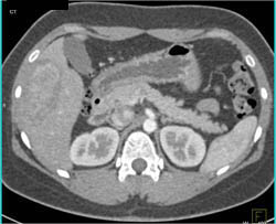 Hepatic Adenoma - CTisus CT Scan