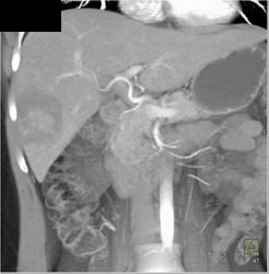 Hepatic Adenoma - CTisus CT Scan