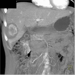 Hepatic Adenoma - CTisus CT Scan