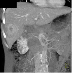 Hepatic Adenoma - CTisus CT Scan