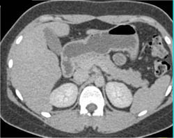 Focal Nodular Hyperplasia (FNH) Which Disappears on Venous Phase - CTisus CT Scan