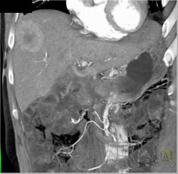 Focal Nodular Hyperplasia (FNH) - CTisus CT Scan