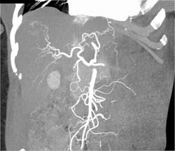 Hemangioma in Various Presentations - CTisus CT Scan