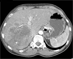 Hepatoma in Various Presentations - CTisus CT Scan