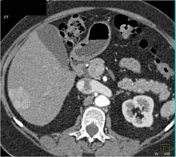 Focal Nodular Hyperplasia (FNH) in Various Presentations - CTisus CT Scan