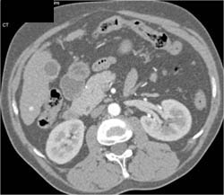 Tiny Vascular Nodules C/w Av Shunting - CTisus CT Scan