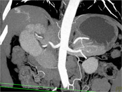 1 Cm Hepatoma in A Cirrhotic Liver - CTisus CT Scan