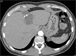 Complex Cyst - CTisus CT Scan