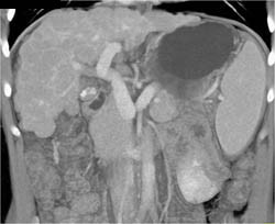 Nodular Liver in Cirrhosis - CTisus CT Scan