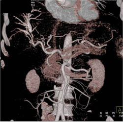 Cholangiocarcinoma With Contrast in Obstructed Ducts - CTisus CT Scan