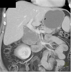 Pancreatic Hemangioma - CTisus CT Scan