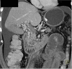 Cirrhosis With Portal Vein Thrombosis (PVT) and Cavernous Transformation of the Portal Vein - CTisus CT Scan