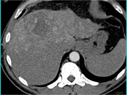 Hepatoma and Incidental Pe - CTisus CT Scan