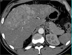 Hepatoma - CTisus CT Scan