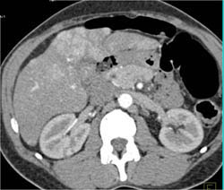 Hepatoma - CTisus CT Scan