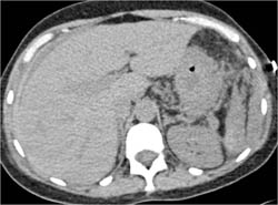 Peri-hepatic Bleed Due to Stab Wound - CTisus CT Scan